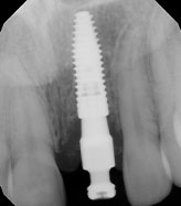 implants